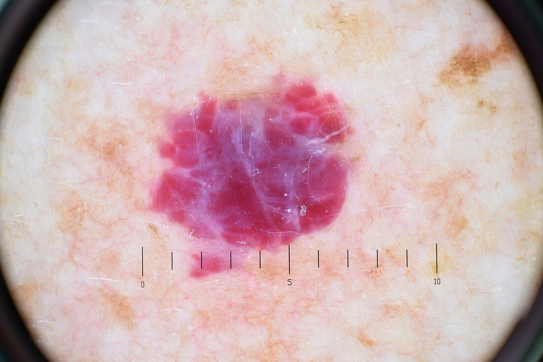 Capillary haemangioma, dermatoscopy image