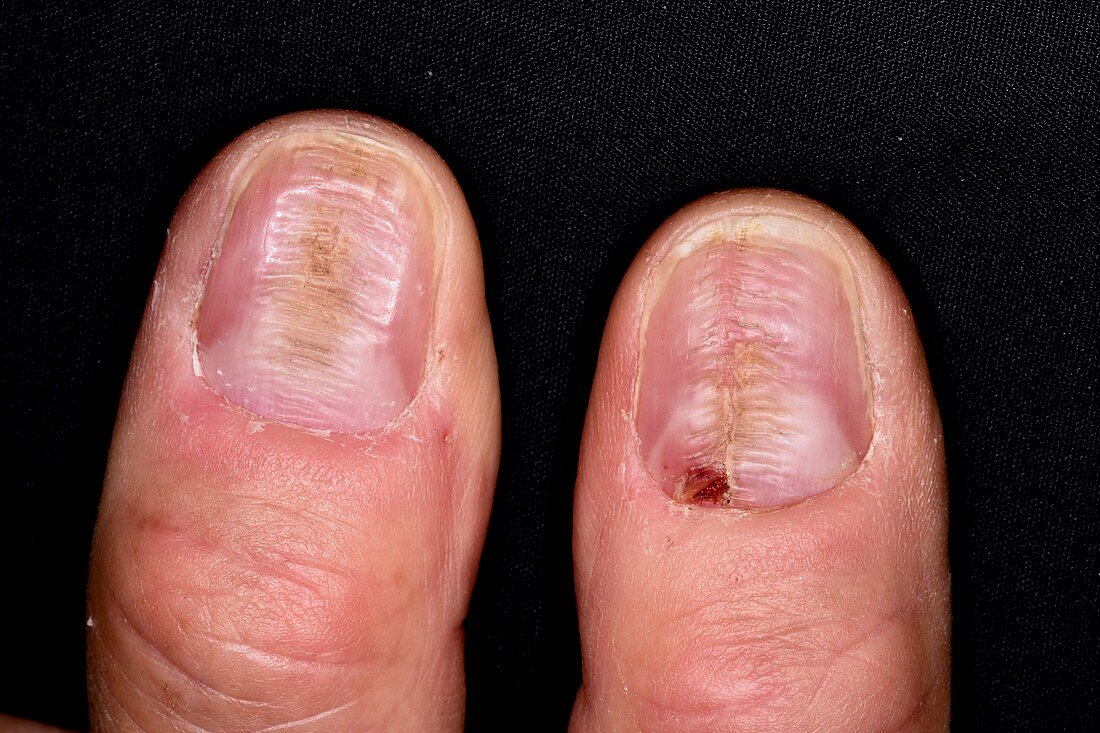 Ridged fingernails