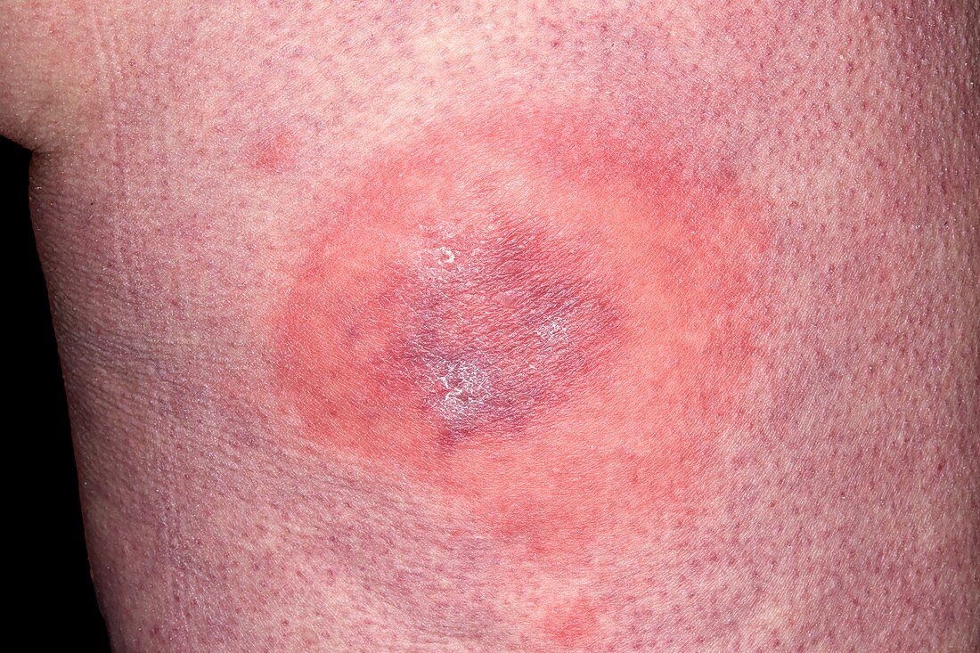 Chilblain on thigh