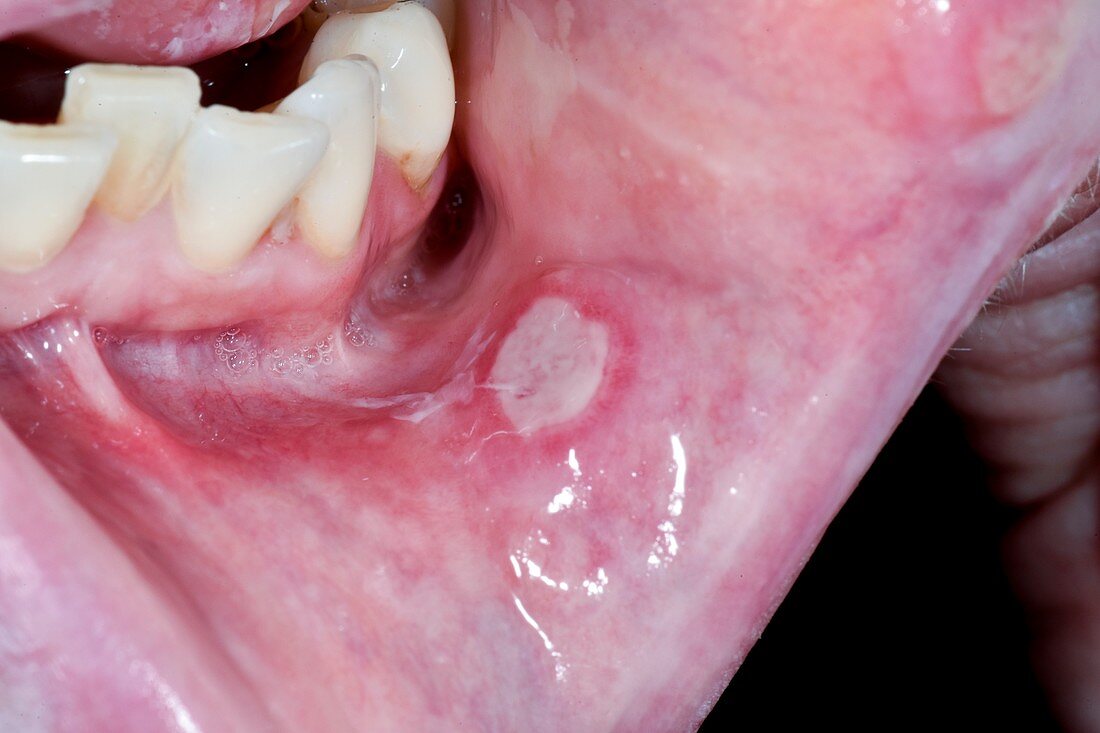 Mouth ulcer in anaemia
