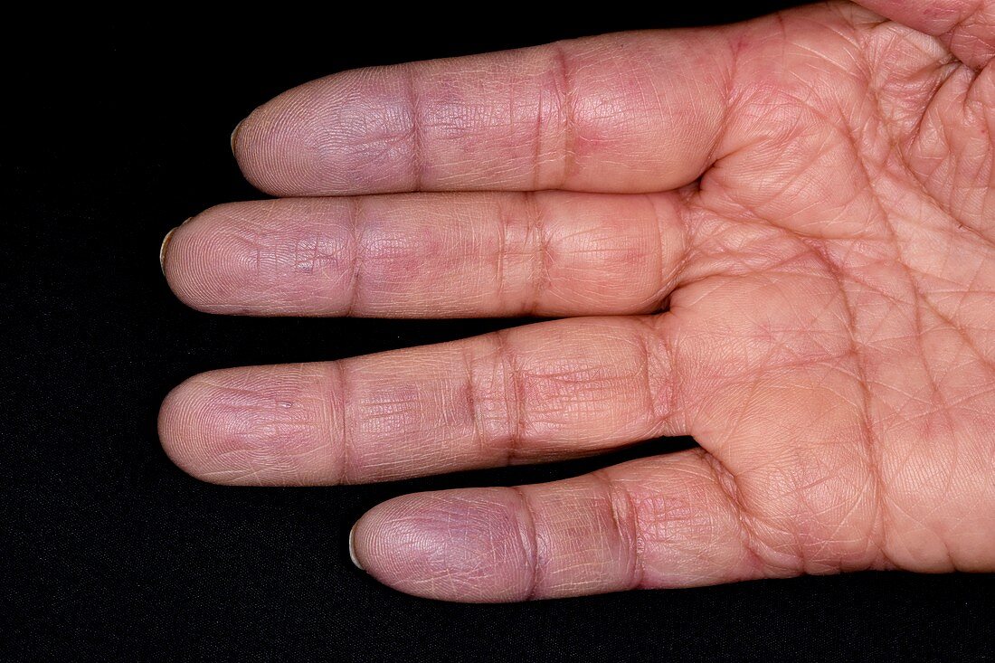 Raynauds phenomenon in CREST syndrome