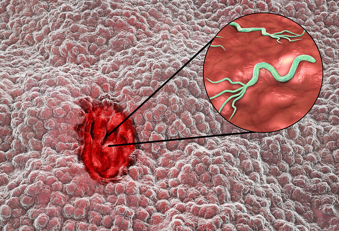 Gastric ulcer and bacterium Helicobacter pylori, illustratio