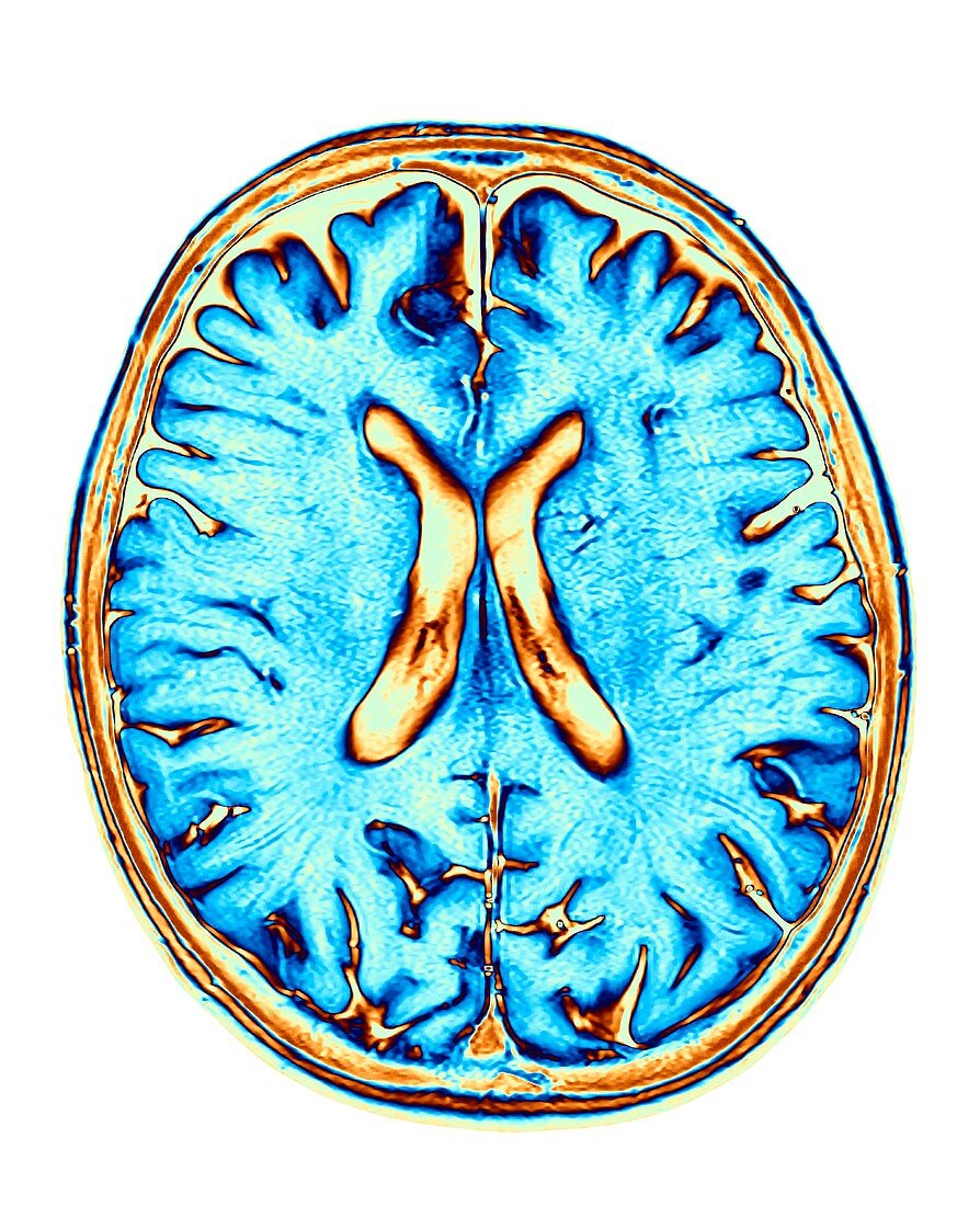 MRI Brain scan of the human head