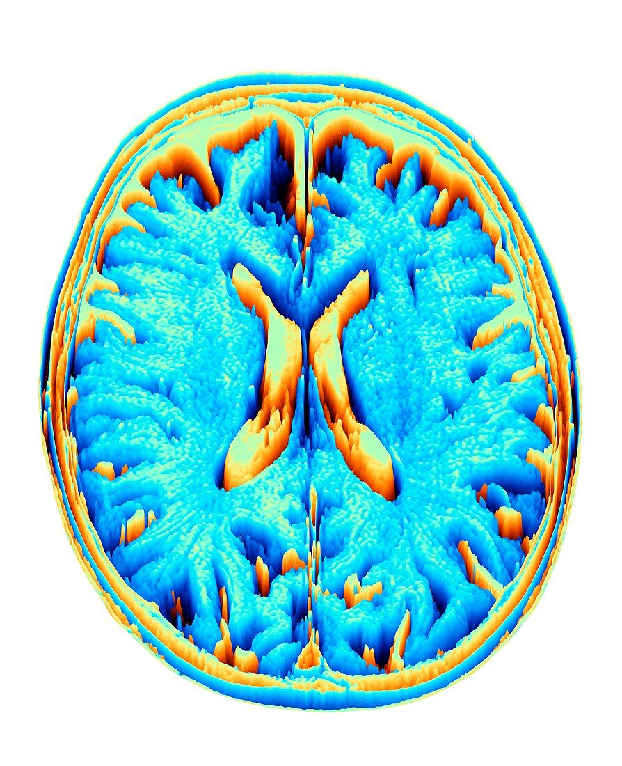 MRI Brain scan, heightmap