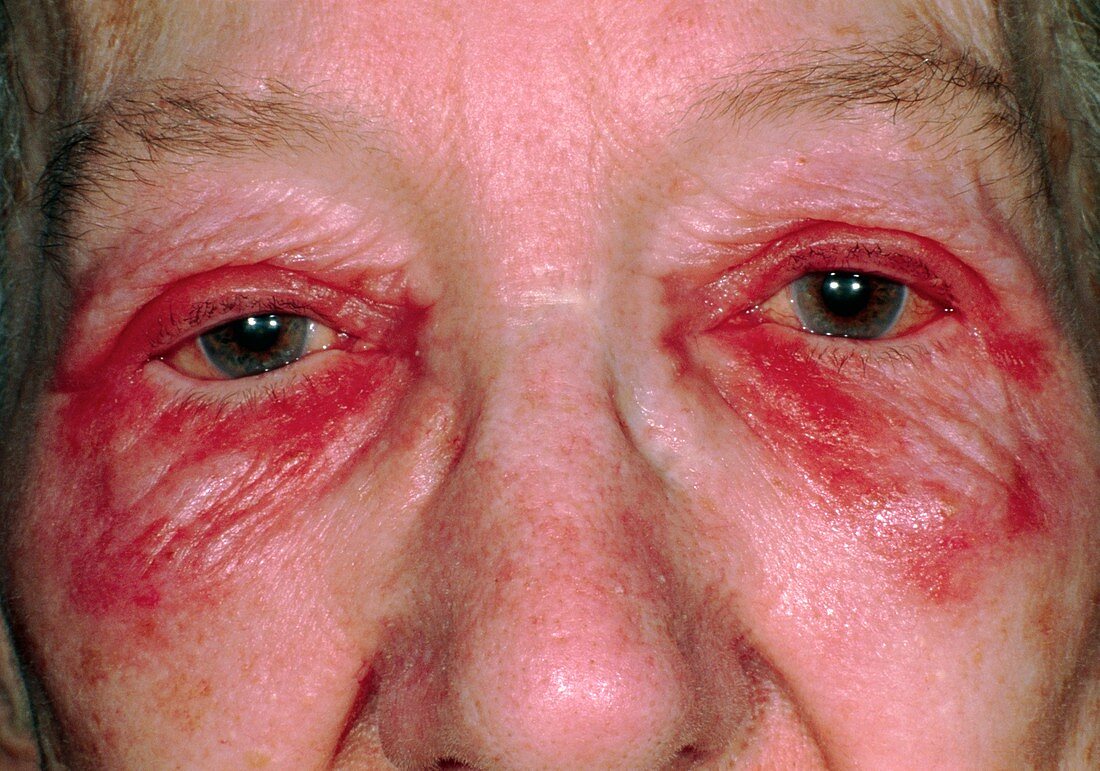 Allergic conjunctivitis due to Alphagan eye drops