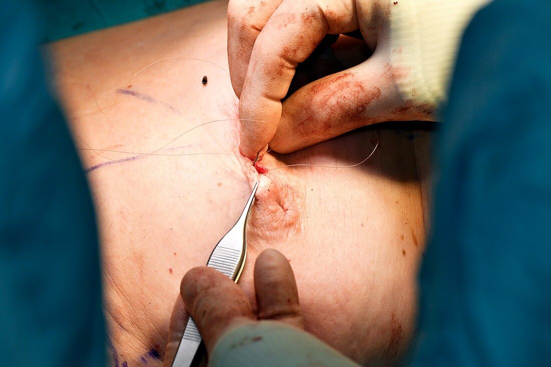 Suturing after breast cancer surgery