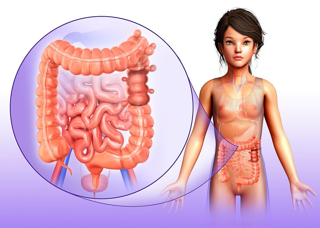 Child with diverticulosis, illustration