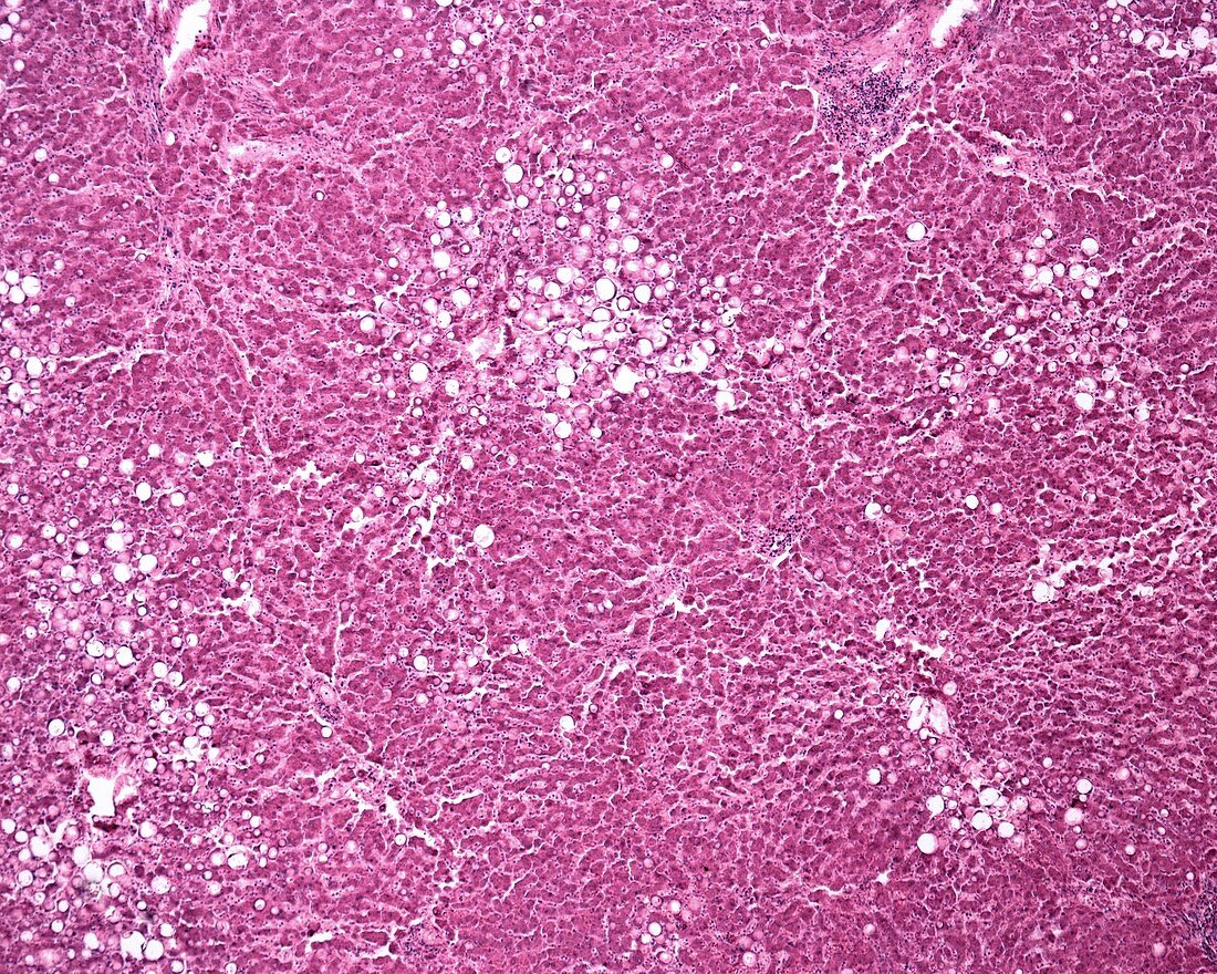 Fatty liver, light micrograph