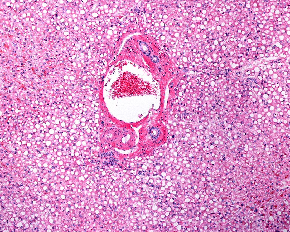 Fatty liver, light micrograph