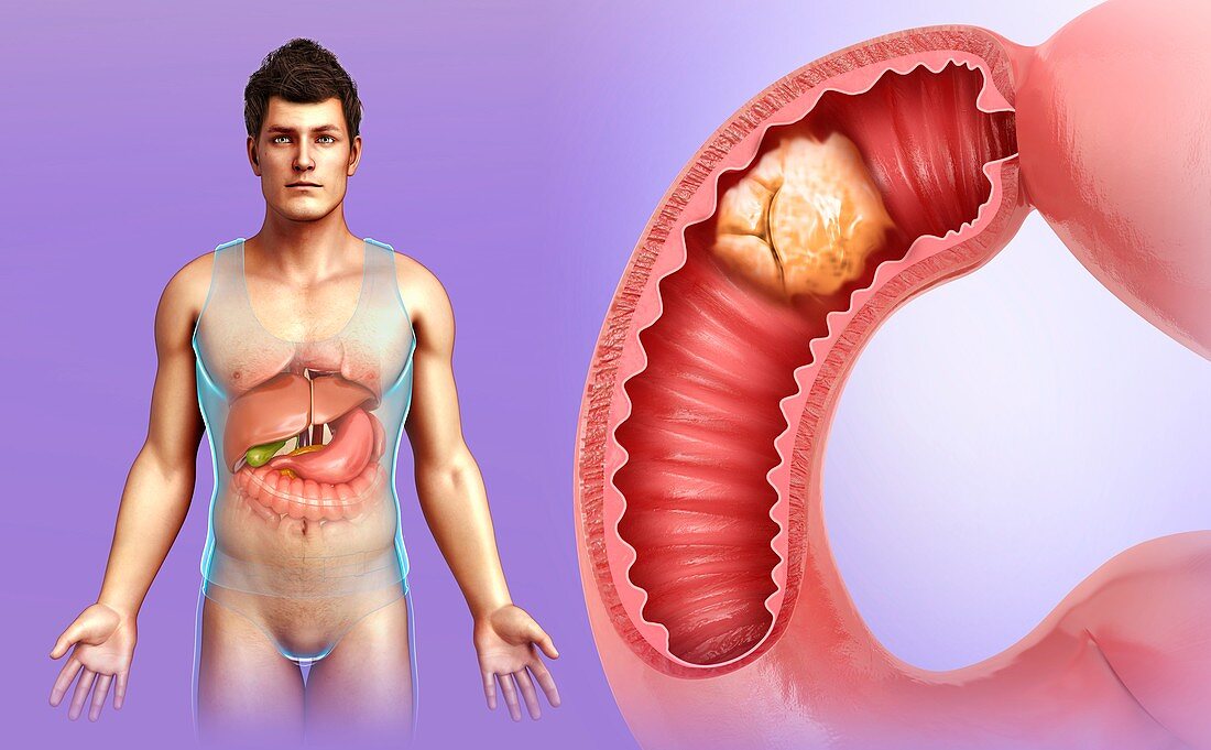 Man with intestinal cancer, illustration