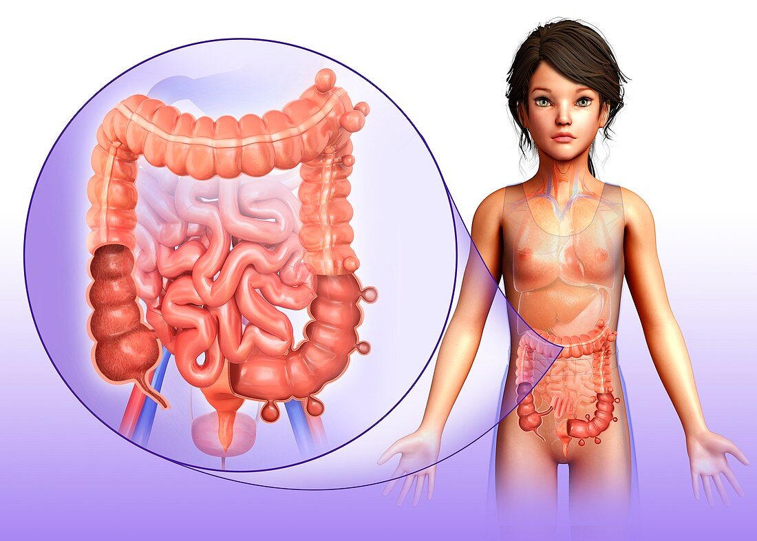 Child with diverticulosis, illustration