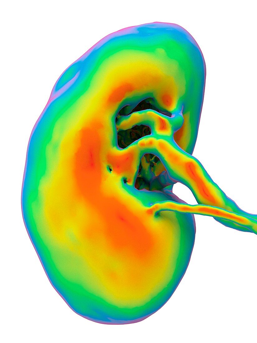 Kidney CT scan