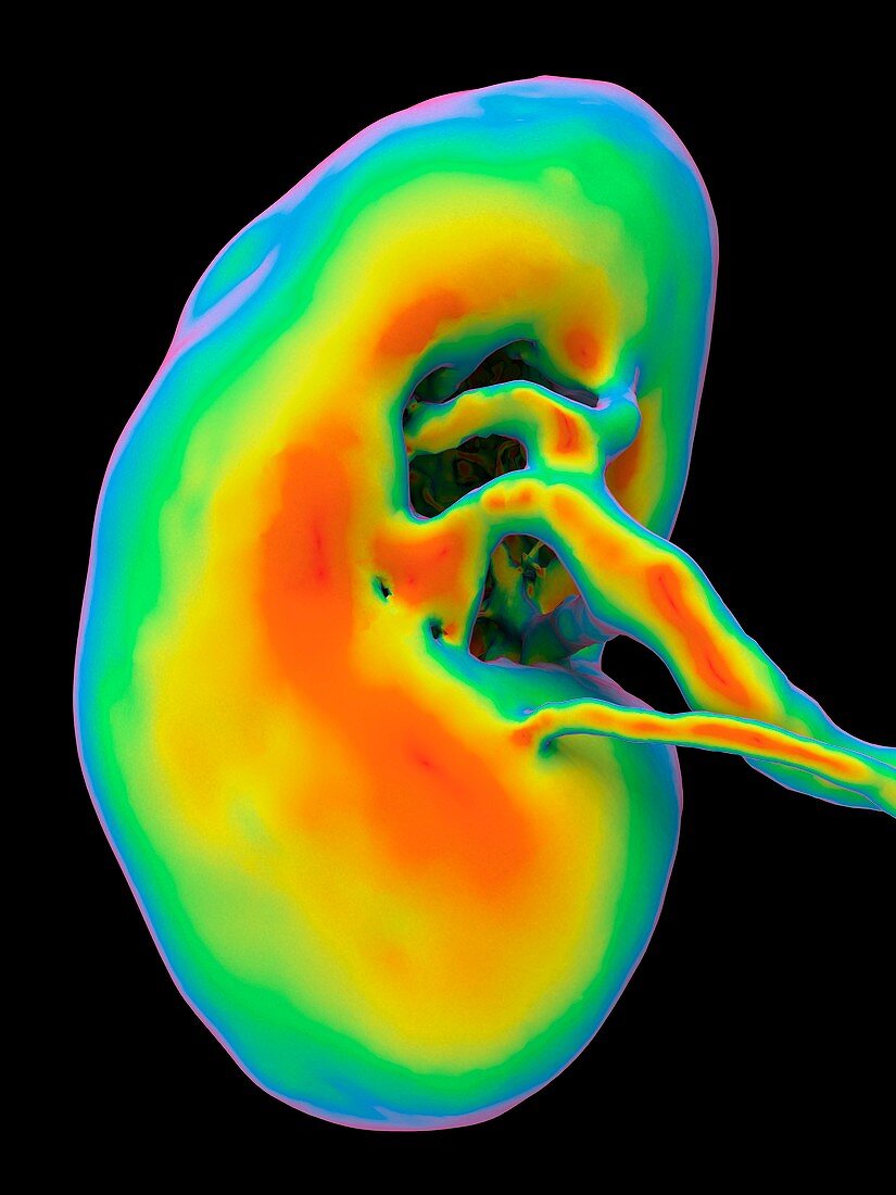 Kidney CT scan