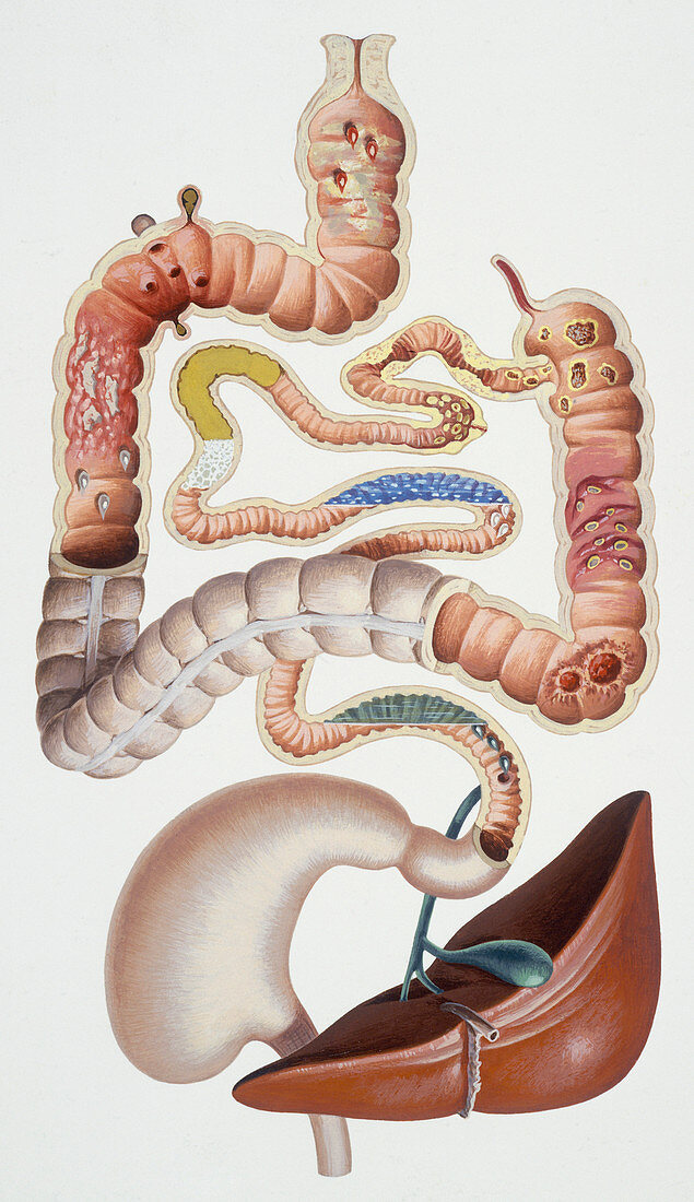 Diarrhoea, illustration