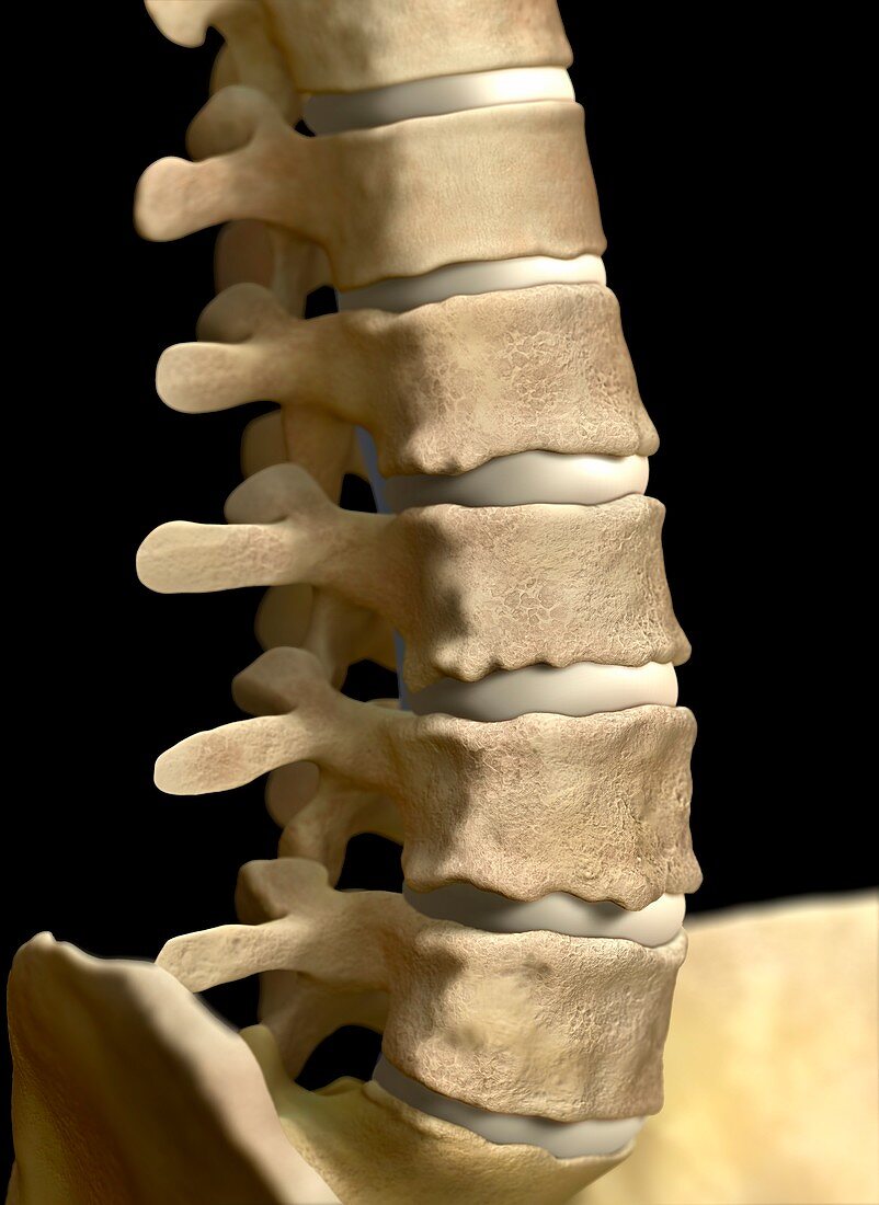 Degeneration of lumbar vertebrae, illustration