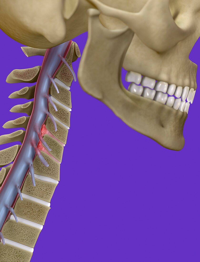 Whiplash neck injury, illustration