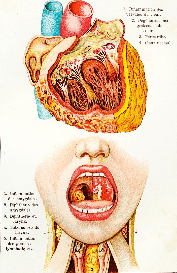 Heart and throat diseases, 19th C illustration