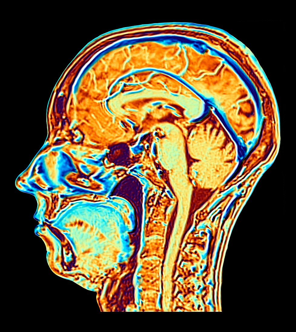 MRI scan of normal brain, artwork