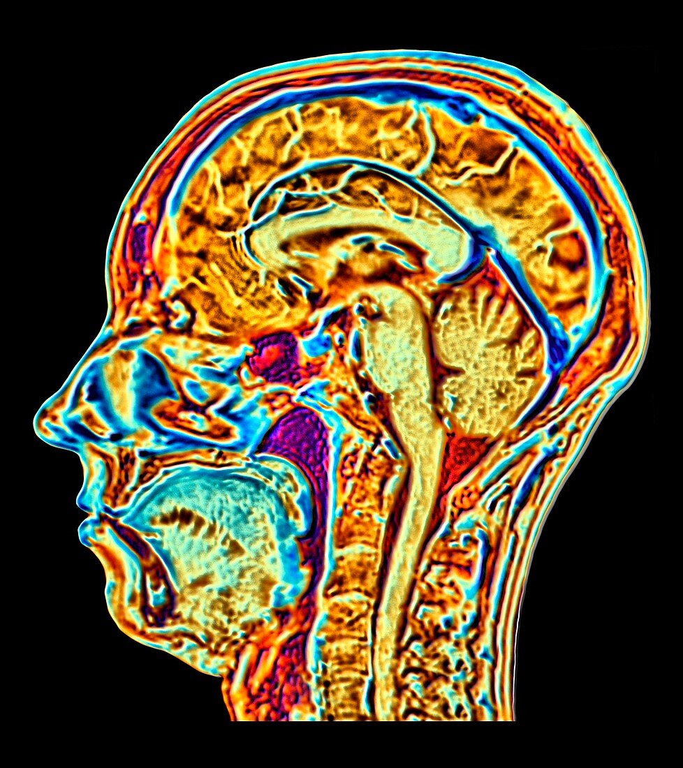 MRI scan of normal brain, artwork