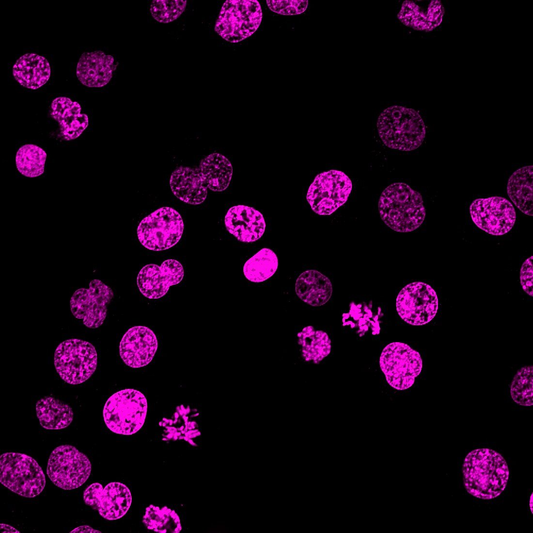 Leukaemia cancer cells, fluorescence light micrograph
