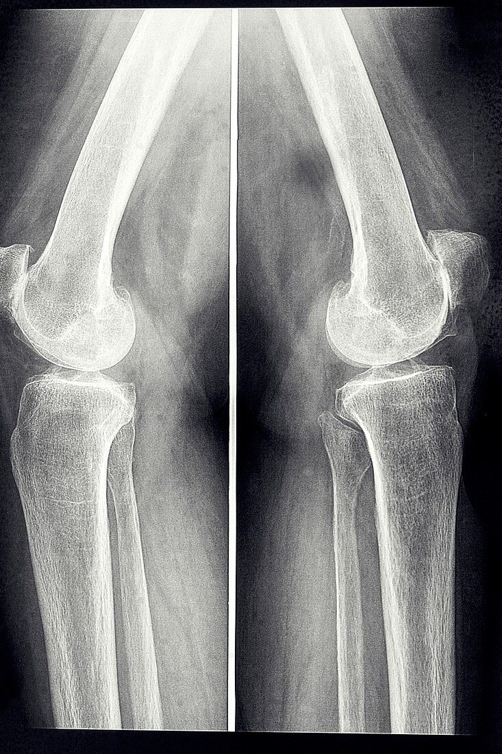 Osteoarthritis of the knees, X-ray