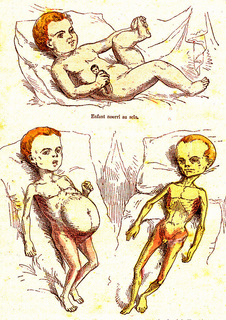 Healthy and malnourished children, 19th Century illustration