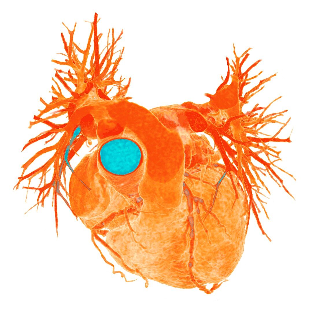 Heart with coronary artery disease, 3D CT scan