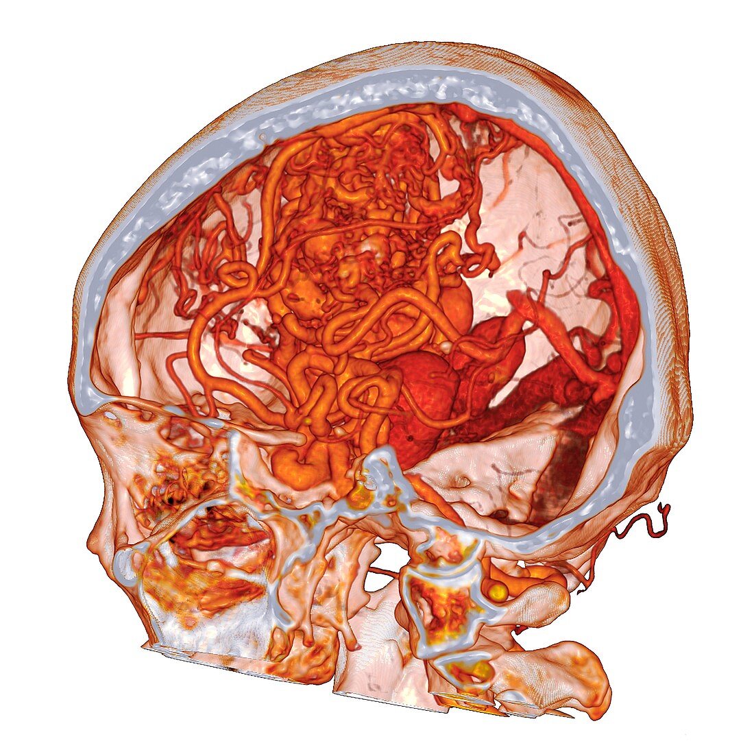 Cerebral arteriovenous malformation, 3D CT scan