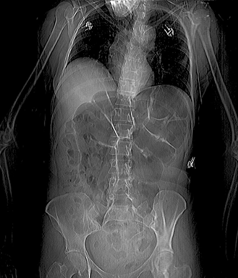 Intestinal gas and swollen abdomen, CT scan
