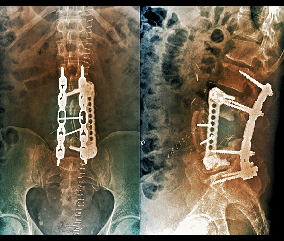 Implants following spinal surgery, X-rays