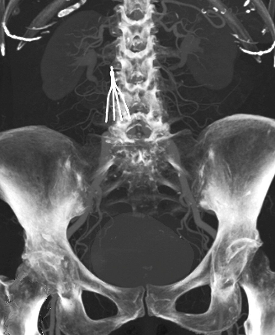 IVC filter implanted in abdomen, CT scan