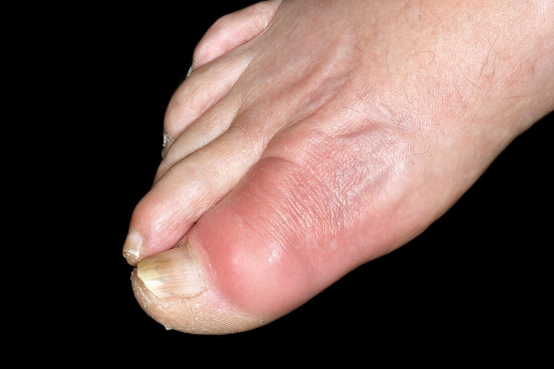 Gout of the big toe