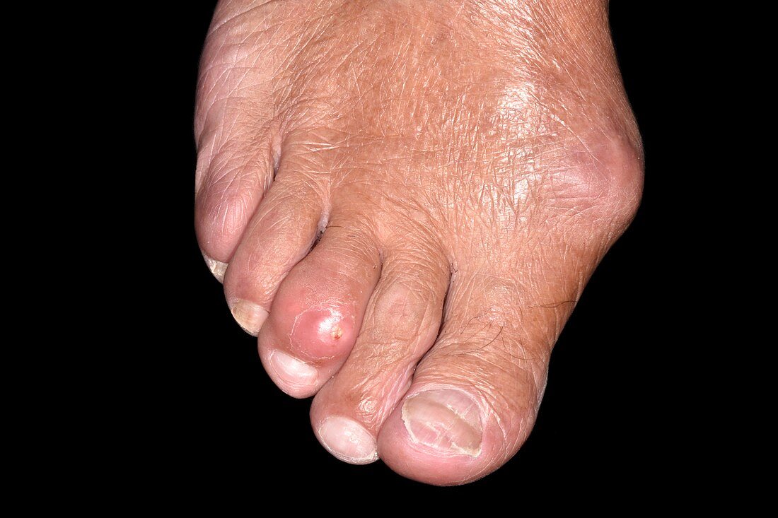 Bunion and gout