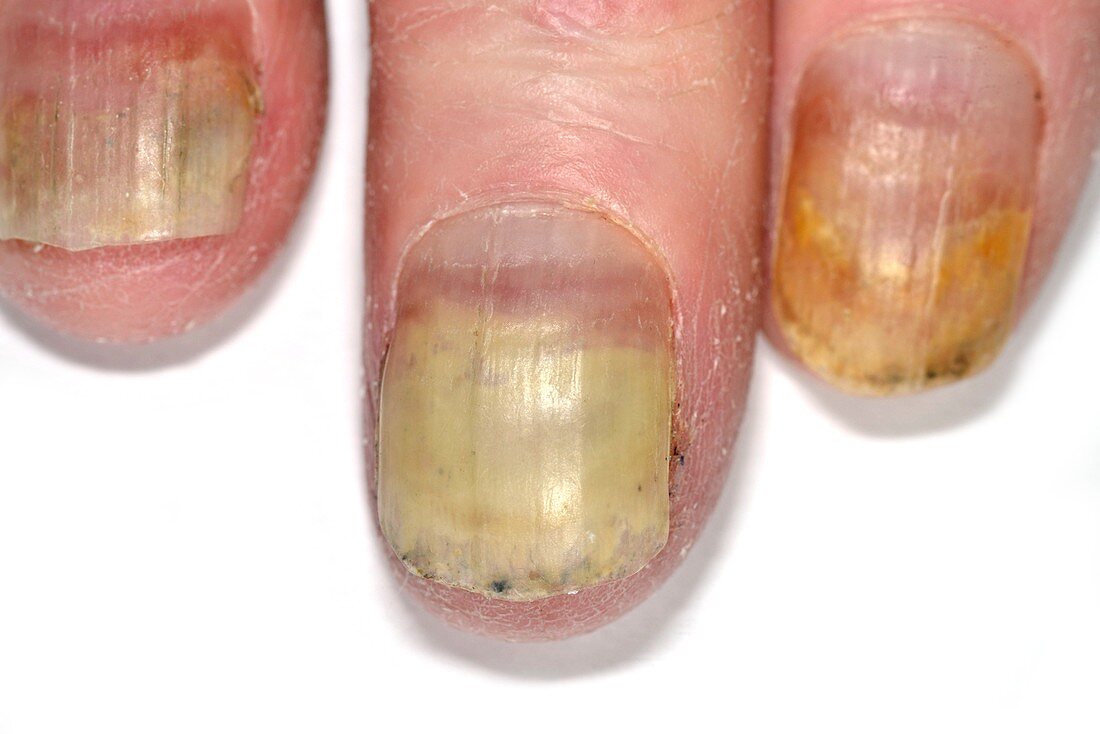 Dystrophic fingernails due to chemotherapy