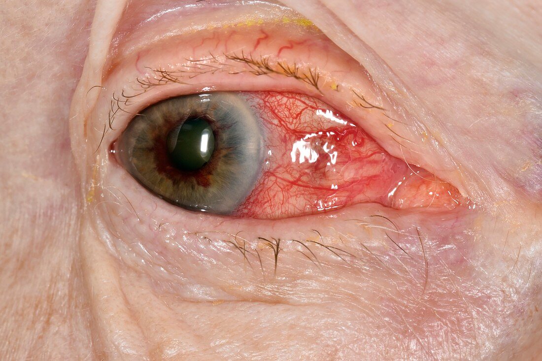 Acute glaucoma in a blind eye