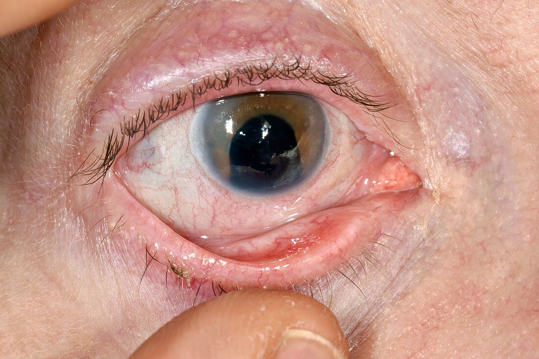 Coloboma and aphakia of the eye