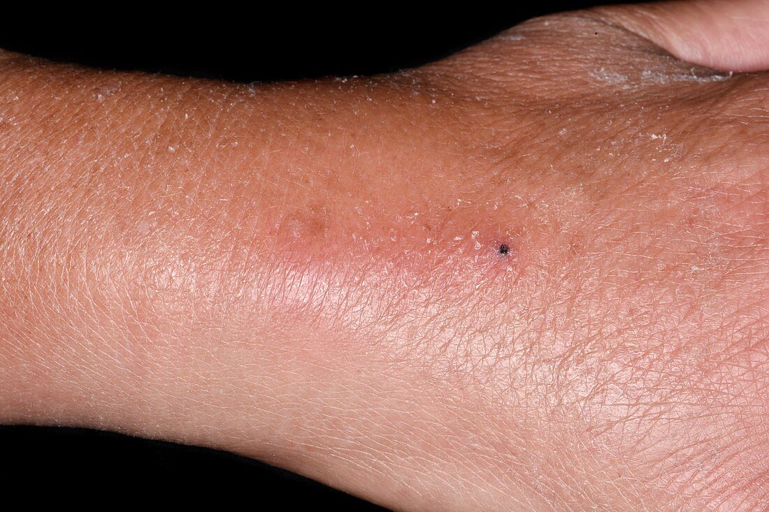 Inflammation at intravenous cannula site