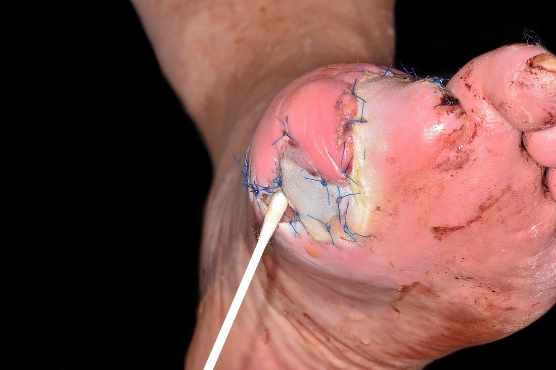 Swabbing toe amputation site for bacteria