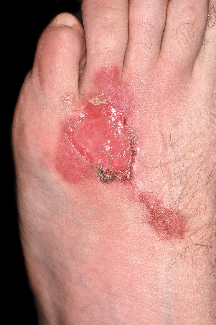 Burns to foot after one week