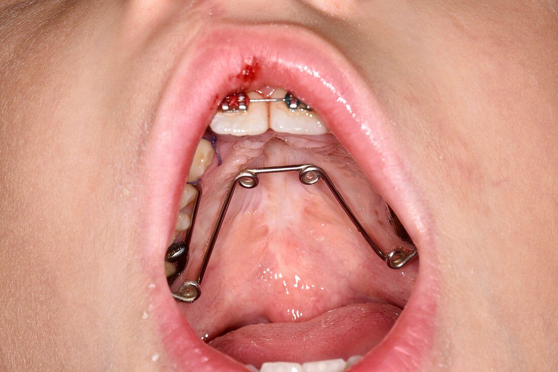 Brace after bone graft for cleft lip and palate