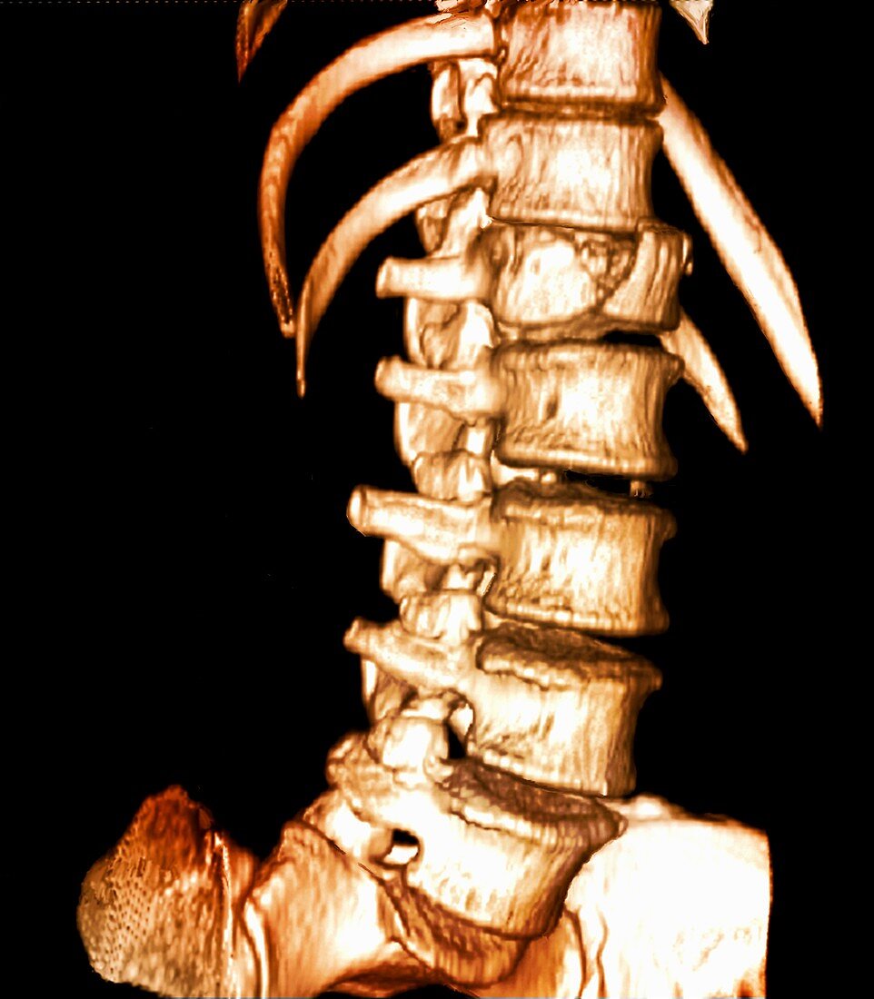 Spinal injury, 3D CT scan