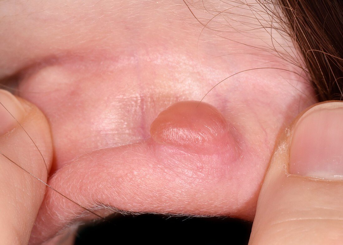 Keloid scarring at ear piercing site