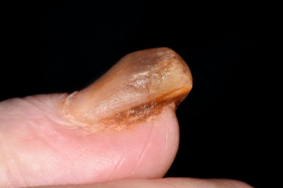 Fingernail in pachyonychia congenita