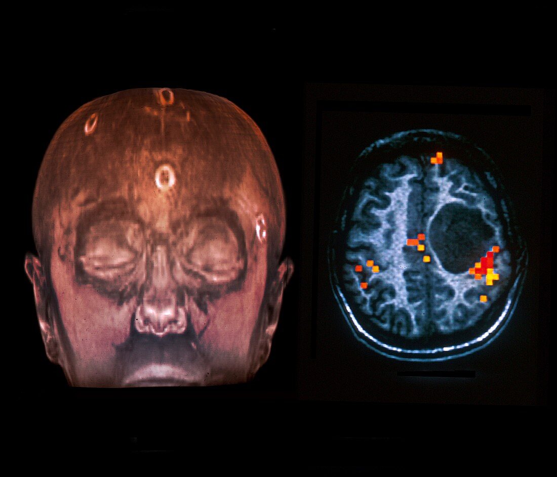 Brain lesion, MRI scans