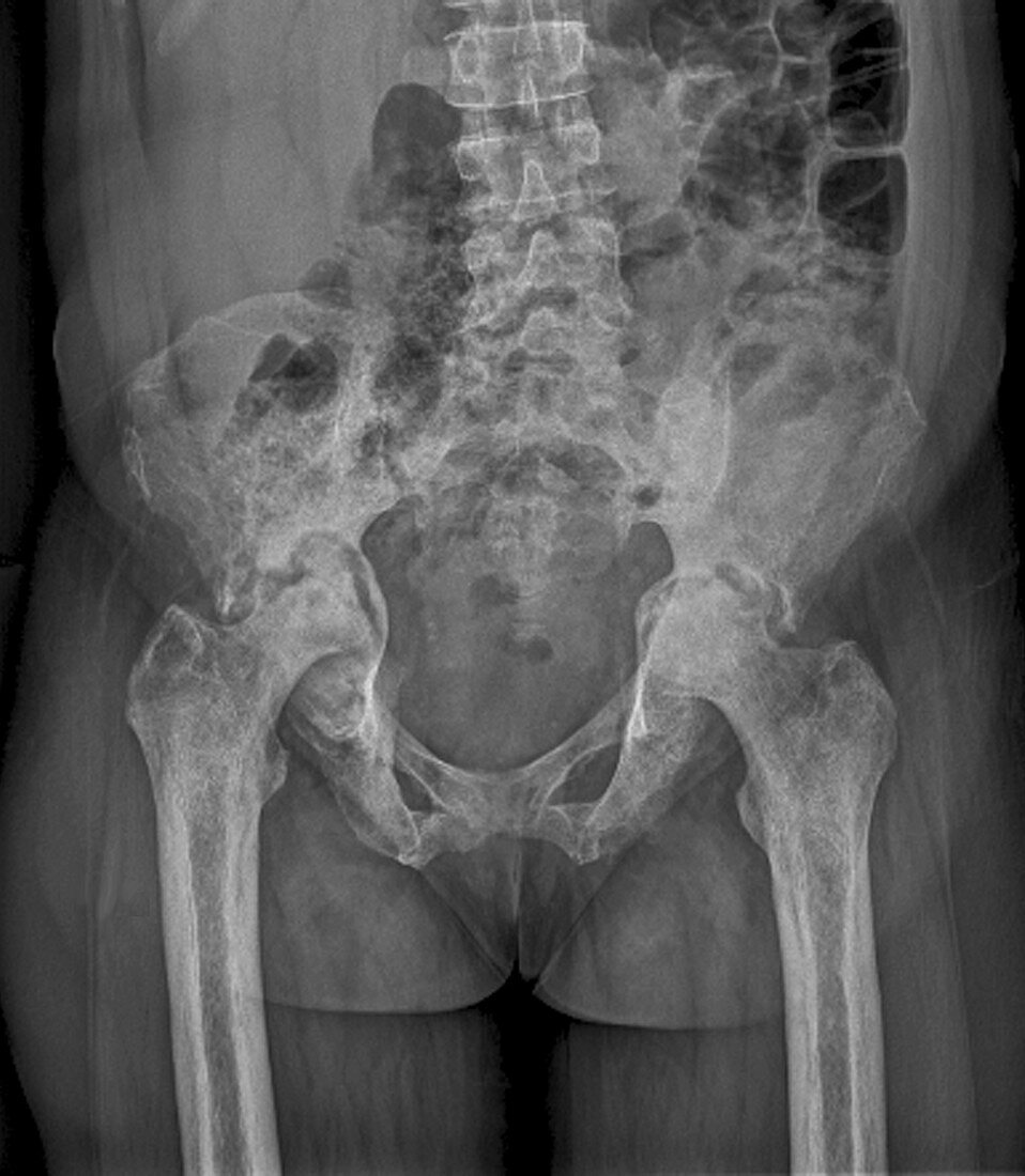 Osteonecrosis of the hip, X-ray