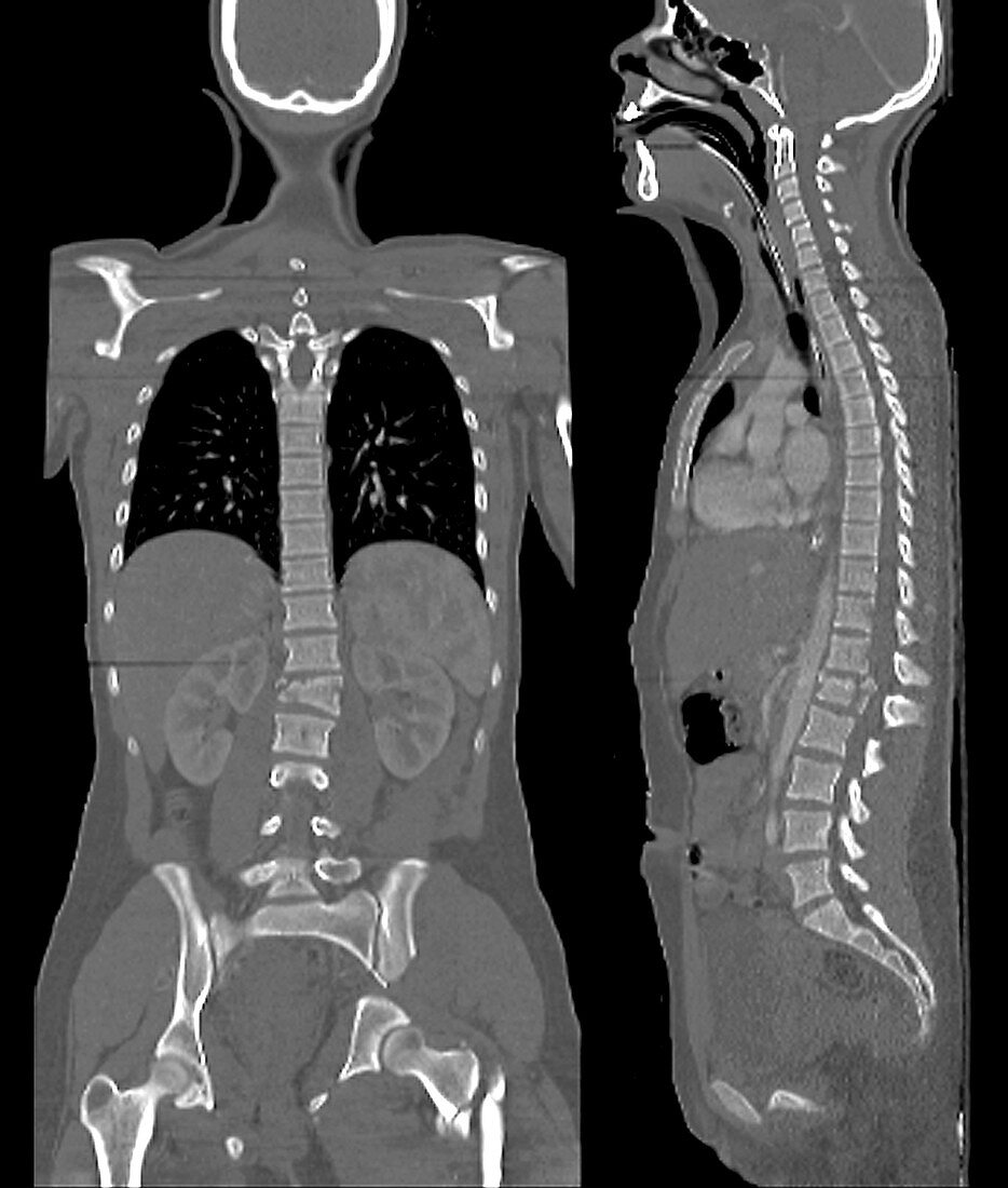 Spinal and pelvic fractures, CT scans