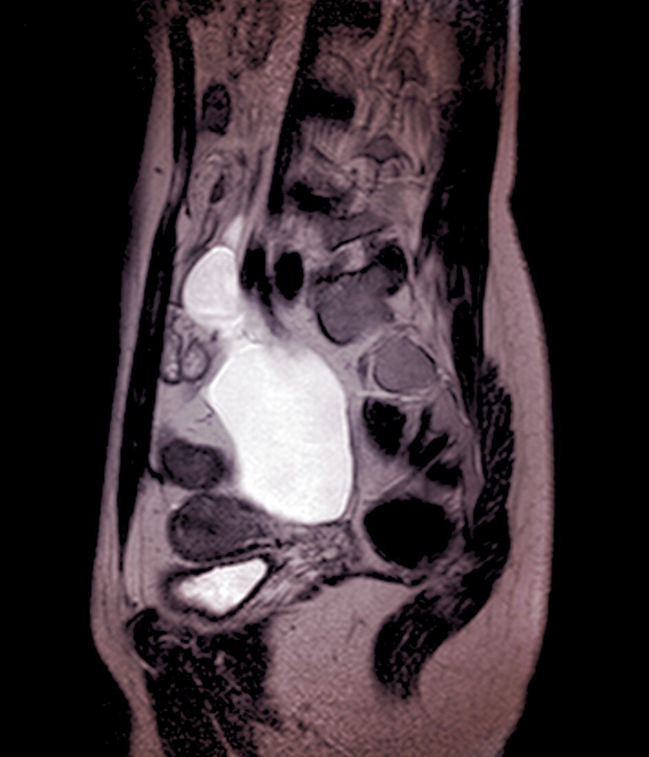 Hydrosalpinx, MRI scan