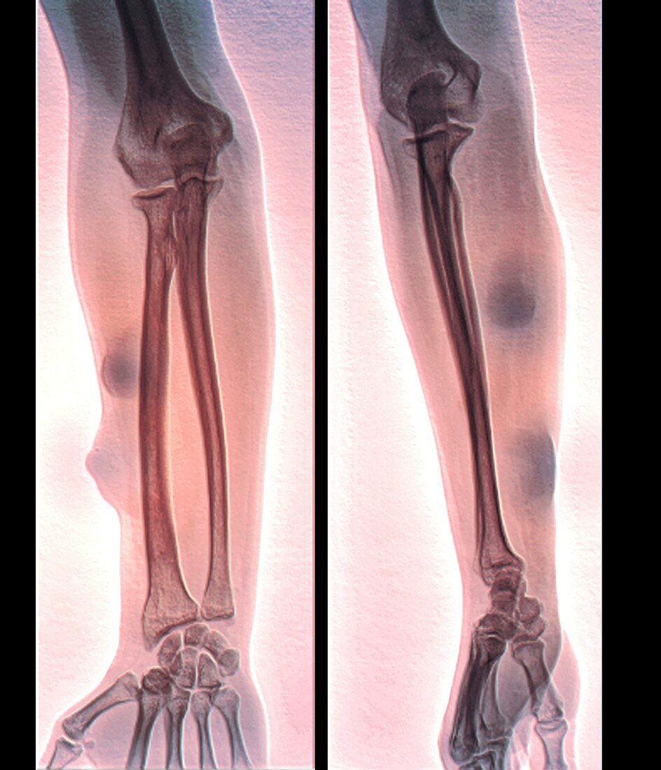 Subcutaneous lipomas on the arm, X-rays