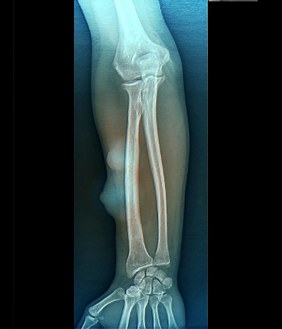 Subcutaneous lipomas on the arm, X-ray