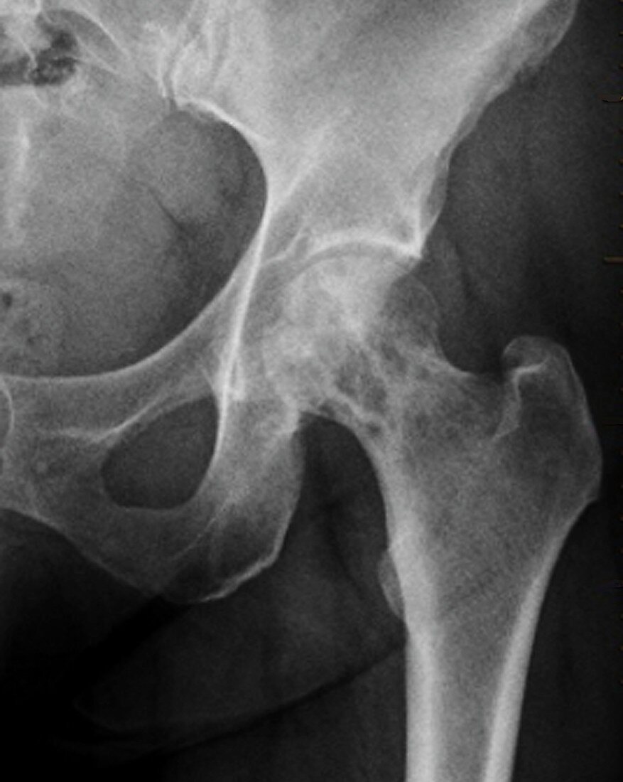 Secondary bone cancer in the hip, X-ray